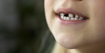 🦷 The Cavity Chronicles: When I Got Teeth-Shamed by the Dentist